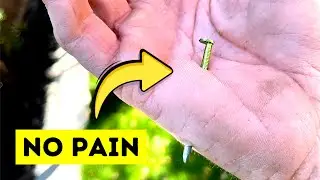 This Women Can’t Feel Pain
