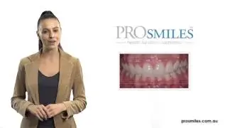 Digital Smile Analysis - ProSmiles Dental