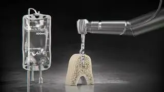 Straumann&reg; BLX Implant System - Intermittent Drilling with Sterile Cool Water