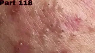 Eliminate all . help this girl more confident .. Part 118  | B'Young Spa Quyet Hair