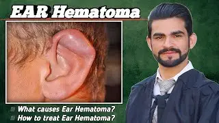 Ear hematoma || causes, treatment, complications