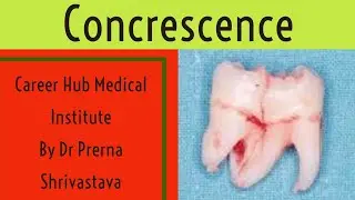 concrescence Developmental tooth anomaly By Dr Prerna Shrivastava career Hub medical institute