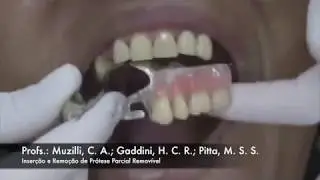 Inserção e Remoção de PPR