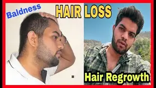 How To Stop HAIRFALL | USTRAA Hair Growth Vitalizer | Regrow Hair With This 🔥🔥