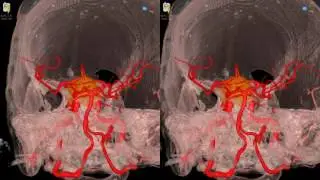 Cavernous Meningioma - 3D Virtual Tour | UCLA Neurosurgery