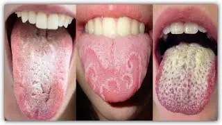 Know the serious symptoms of the disease that causes the tongue to turn white @DoctorsTips