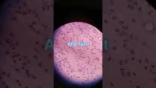 Sputum for AFB Test||AFB Slide test||Sputum test in hindi||बलगम टेस्ट|sort video||DMLT|MLT