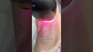 Underarm Laser Hair Reduction: Everything You Need To know | Dr. Sarin |