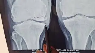 KNEE KA BEST TREATMENT BY DR JP VERMA FROM VARANASI CONTACT NUMBER 8853380309.7784809921 