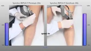 DEKA Synchro Replay Alexandrite Lazer www.orcemmedikal.com.tr