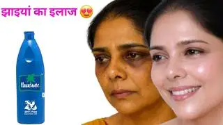 मेरी 10 साल पुरानी झाइयां 2 बार इसे लगाने से चली ही गई,में बहुत गोरी हुई,