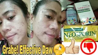 SKINMATE SHARK OIL + NEOSPORIN FOR ACNE PRONE SKIN REVIEW | GERLY DENOSTA