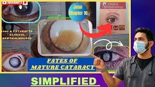 Fates of Mature Cataract | Jatoi Clinical Ophthalmology | Chapter 10 Part 6