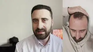 Cum arată părul meu după aproape șapte luni de la implant | Estemark Clinic