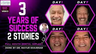Full Mouth Dental Implants Treatment 🦷😁 | Permanent Teeth, Lasting Confidence💫🦷 - Dr Mayur Khairnar