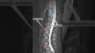BCV Expert Talk &ndash; March 25th at 16:00 CET &ndash; axSpA Spine