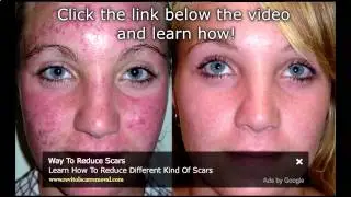 Watch Bio Oil Acne Scars: Before & After Results - Bio Oil Acne Scars Before And After