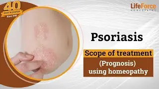 Tratamiento homeop&aacute;tico para la psoriasis: Perspectivas del Dr. Rajesh Shah sobre su curabilidad ...