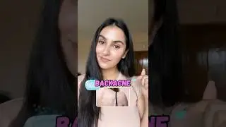 Back acne?   #drshivangirana #dermatologist