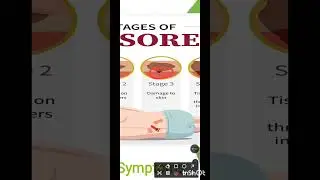 Bed sore #Pressure ulcer #Decubitus ulcer#stages of bed sore#management#youtubevideo 