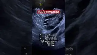 PCOS symptoms, polycystic ovarian syndrome ultrasound, ARDMS sonography, infertility, ob-gyn