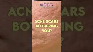 MNRF LASER for Acne scars treatment at DIYA SKIN HAIR LASER CLINIC NAGARAM #praveenkumarboppani