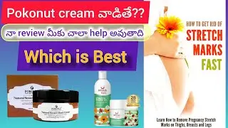 Stretch marks ki bye bye #pokonut cream review #mylo strecth marks cream what is best