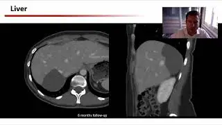 Clinical benefit of using Canon Angio-CT in Interventional Radiology &ndash; Julien Garnon