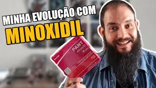 MINHA EVOLUÇÃO COM MINOXIDIL PANT & SAILOR JACK - (DAVID BLACKBEARD)
