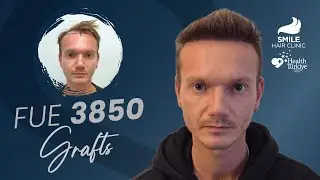 3850 Grafts Transformation | 12-Month Hair Transplant Result | Smile Hair Clinic