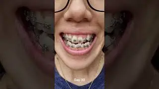 Update: My 7 months braces journey (Class III Underbite)