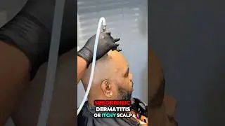 Scalp Facial: The Secret to a Healthy Scalp   #ScalpFacial #HealthyHair #malebaldness  #scalpdetox