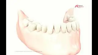 crown and bridge animated