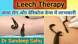 #leechtherapy leech therapy helps acne varicose vein skin disease me @healthandayurveda9967
