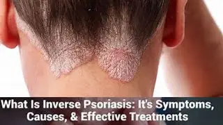 Psoriasis, three ramides, for treatment,