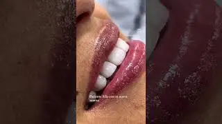 Santa Marta smile design with cosmetic dentist Albeiro Garc&iacute;a #cosmeticdentistry