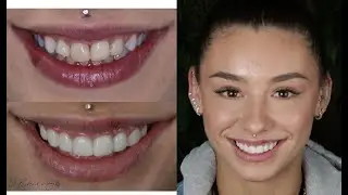 BEST Veneers NATURAL Style Not Too White SMILE Makeover Australia vol. 48 with Dr Richard