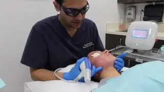 Clear + Brilliant combined with Microneedling for Antiaging and Sun damage (Part 1) | Miami, FL