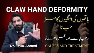 Claw Hand Deformity: Causes, Signs, Symptoms, and Effective Treatment Options