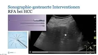 Sonographisch-gef&uuml;hrte Radiofrequenzablation (RFA)