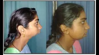 Everything you need to know about facial(Jaw)deformity & how it is treated by Orthognathic surgery.