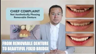 Beautiful Fixed Bridge to Replace Removable Denture | Life Changer | Apostol Dental Philippines
