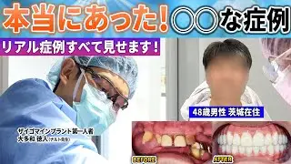大事故にあって歯が抜け始め15年間ずっと悩んでいました！しかも成人病もあり…ナルト先生はオールオン4でどう治したのか？今回は本歯がとにかく美しかった！