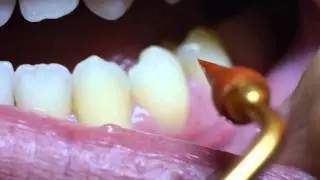 Quickly Learn How to Properly Use a Gum Stimulator