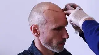 Scalp Micropigmentation | Hair Tattoo @ The Look SMP Melbourne & Sydney