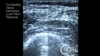 Dry Needling Vastus Intermedius under ultrasound