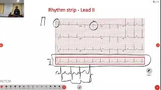 ഇസിജി   മലയാളത്തിൽ ECG Reading in Malayalam for Nursing & Allied Health Care Professionals