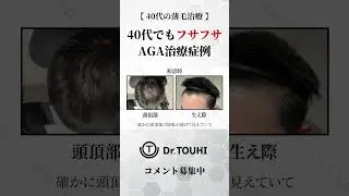 【薄毛治療】40代でもフサフサに！AGA治療症例のリアルをご紹介！