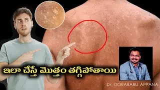 Skin spots | solve skin problem | tinea versicolor | pityriasis versicolor | treatment Telugu