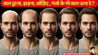 गंजे के सिर पर भी बाल ऊगा दे,यह 20 रुपये वाली गोली | Best Minoxidil Tablets For Hair Fall Problem